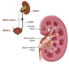 Ảnh 4 của Kidney stone